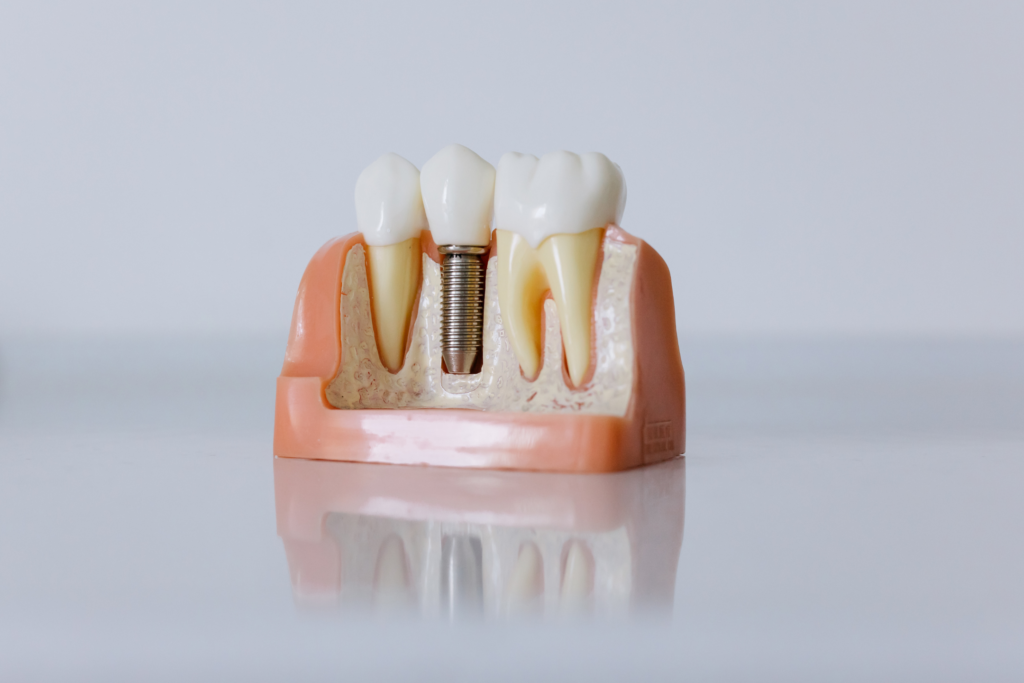 Losing a tooth affects a person’s everyday life on many levels and none of it is pleasant. First and foremost it has an effect on a physical level, making chewing more difficult, and it can cause emotional discomfort as well in case the place of the lost tooth is visible when smiling or speaking.